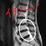 脊柱管狭窄症による腰の痛みの原因は