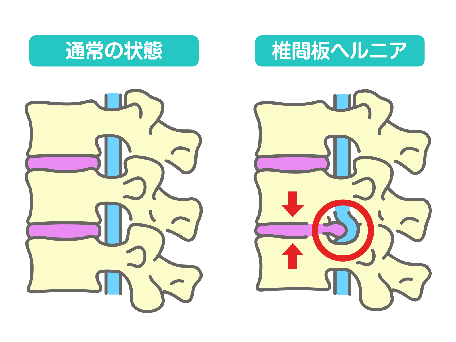 椎間板と神経の位置関係