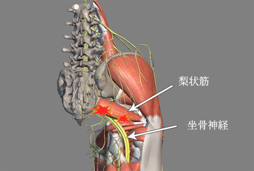 梨状筋が坐骨神経を圧迫