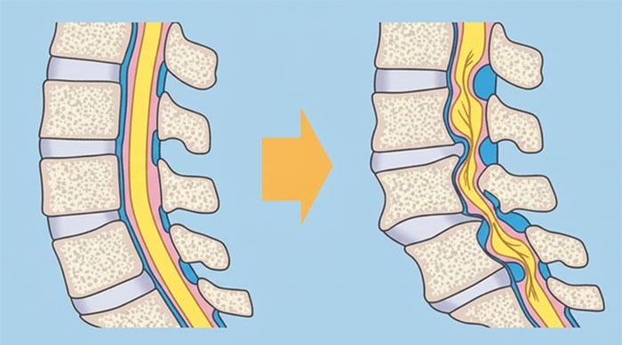 正常な脊柱管と狭窄した脊柱管