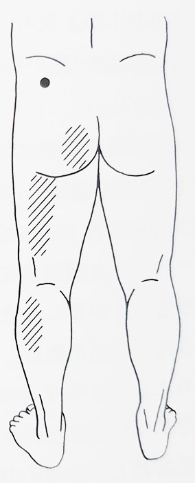 トリガーポイント